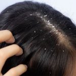 dandruff relief