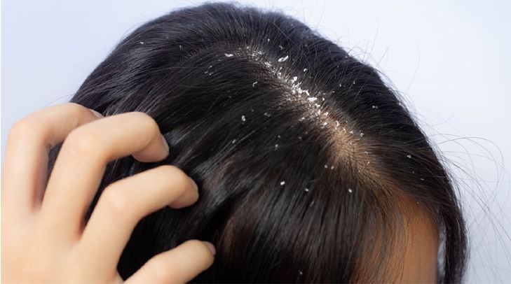 dandruff relief